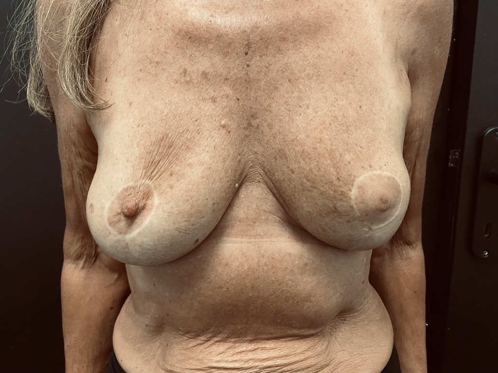 Cicatrices post operatoire