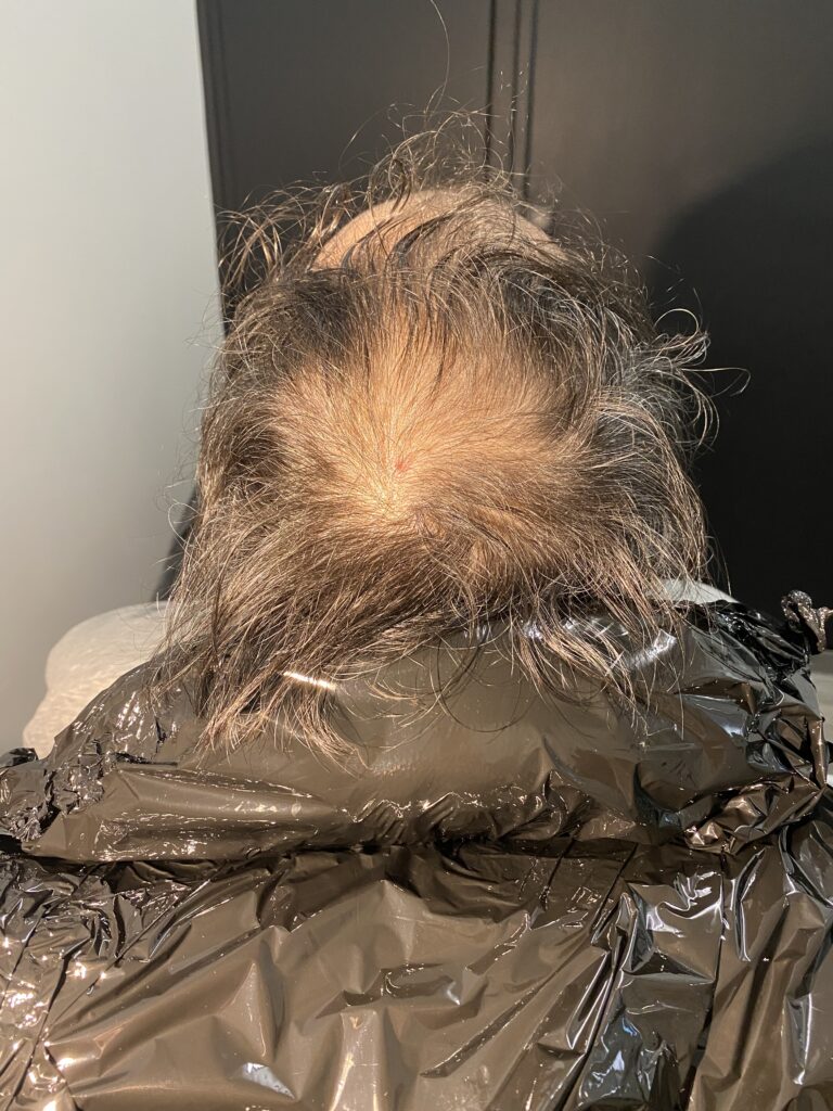 Avant tricopigmentation 